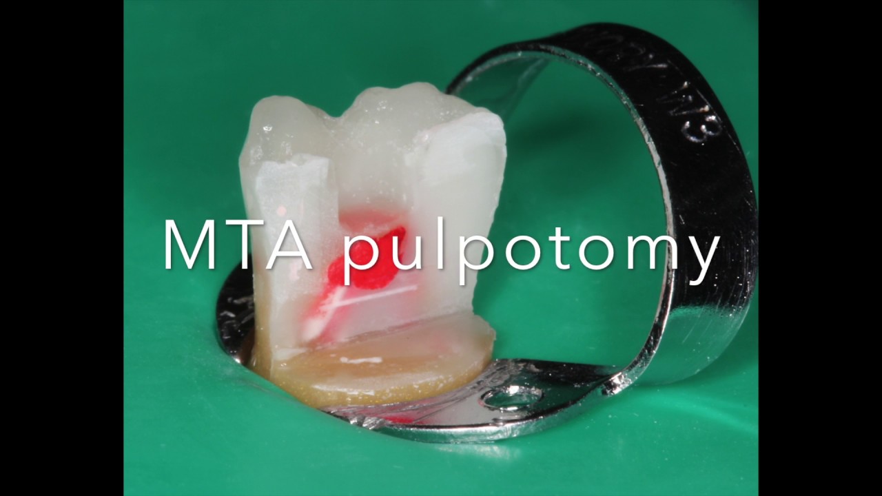 MTA pulpotomy step by step.   by Jorge Casi&aacute;n Adem