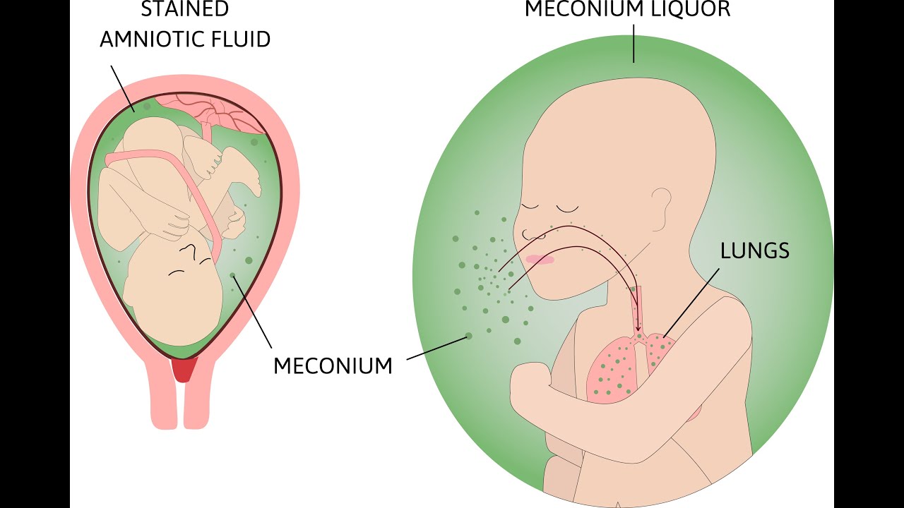 Meconium Aspiration Syndrome and HIE