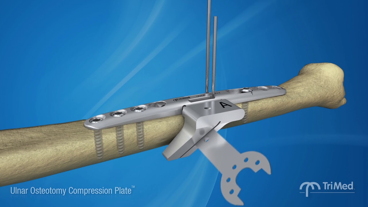 TriMed Ulnar Osteotomy Compression Plate: The market leaders