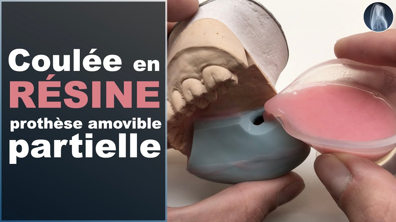 Transformez Vos Maquettes en Cire pour des Prothèses Dentaires Parfaites