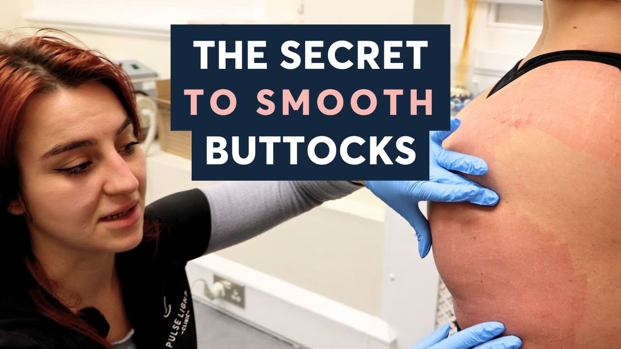 Shocking Stretch Marks Removal | Transformation with Cool Laser