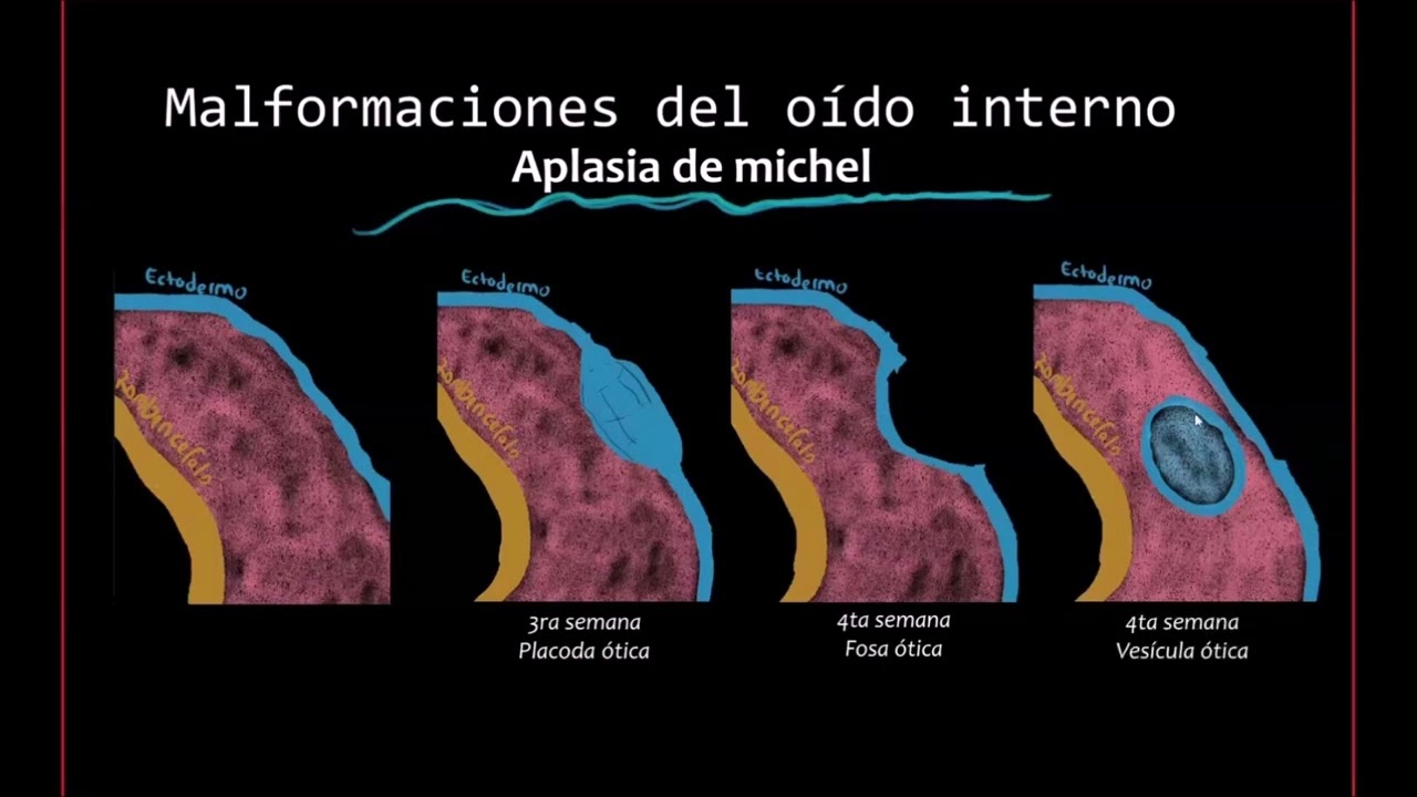 Radiología en 5 minutos: Aplasia de Michel.