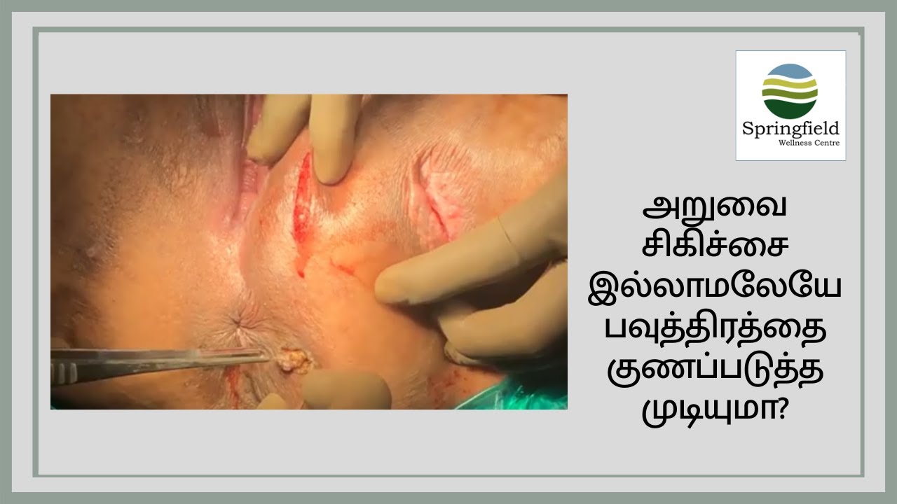 அறுவை சிகிச்சை இல்லாமலேயே பவுத்திரத்தை குணப்படுத்த முடியுமா? பௌத்திரம் அறுவை சிகிச்சை