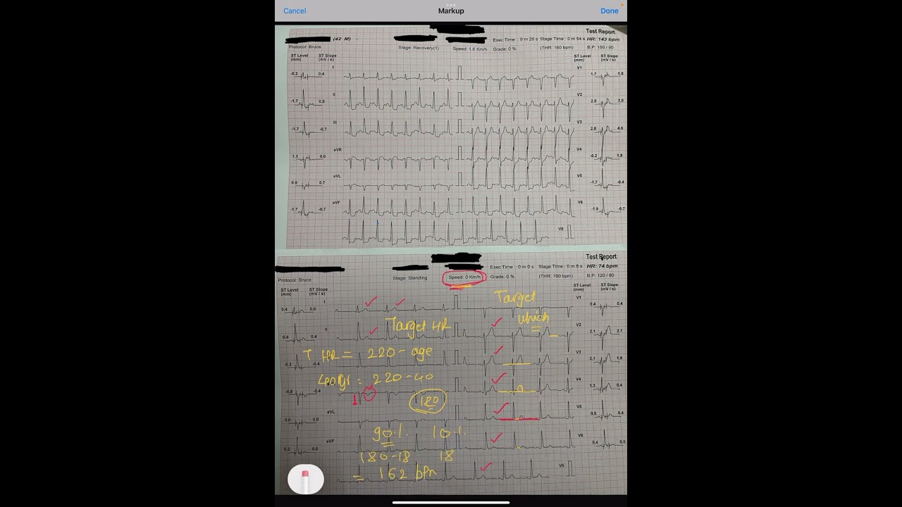 ECG 13-  TREADMILL TEST (TMT) -POSITIVE - HOW TO COME TO KNOW