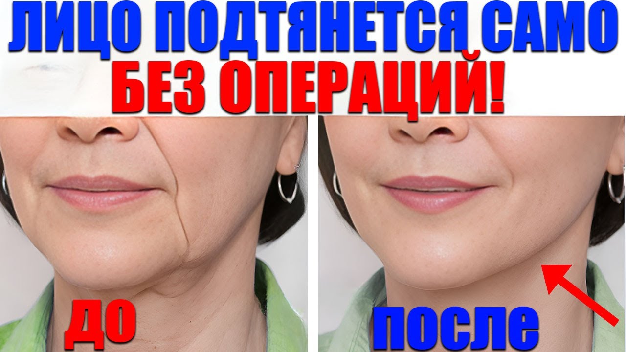 Птоз начинается НЕ с кожи! Скрытая причина — и лицо подтягивается на глазах