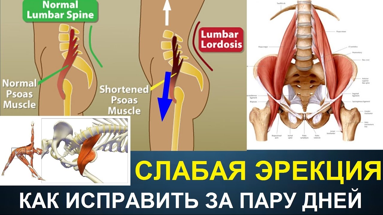 Эректильная дисфункция. Боль в спине. Сгибатели бедра. Back Pain And Erectile Dysfunction