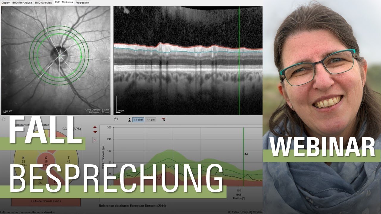 🇩🇪 1. Glaukom Sprechstunde: Fallbesprechung | SPECTRALIS