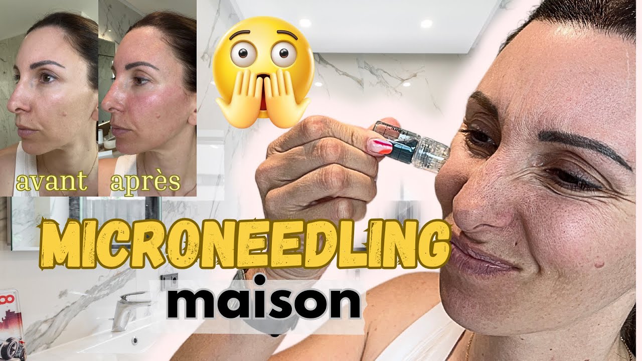 Je TESTE le MICRONEEDLING à la MAISON avec QURE – Résultat en direct !