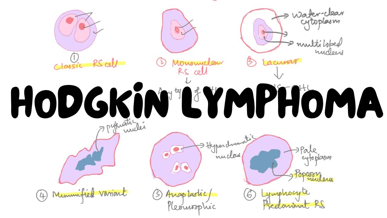 Hodgkin Lymphoma for 2nd Year MBBS | Pathology | Lectures by Omer
