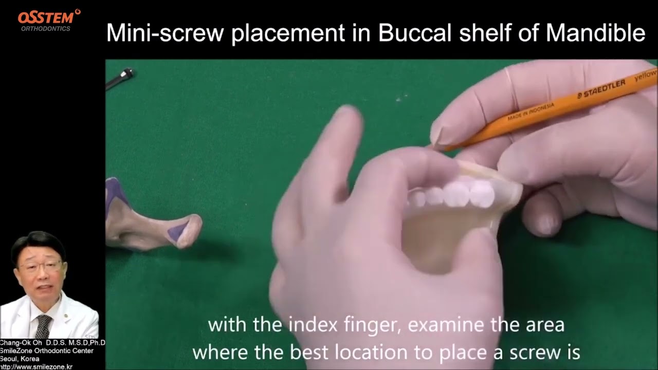 8. Buccal Shelf (When and How to use 