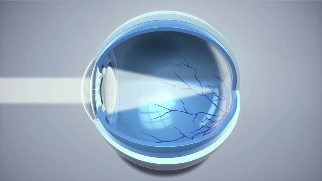 What is presbyopia? | Optical Express