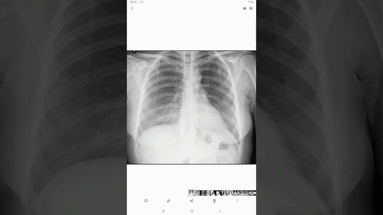 Dr Hilmi Keskin '' Sternum (iman tahtası) kırıkları ''