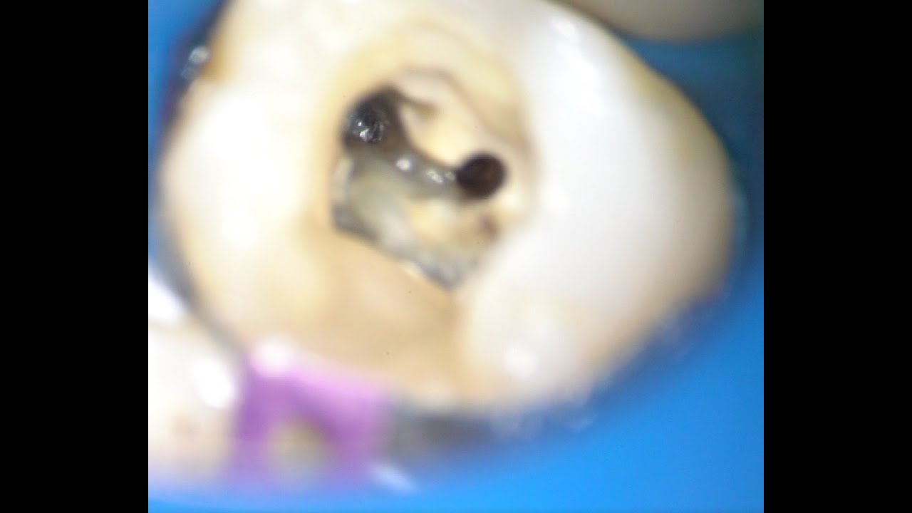 [English] My technique for broken file removal tooth #26