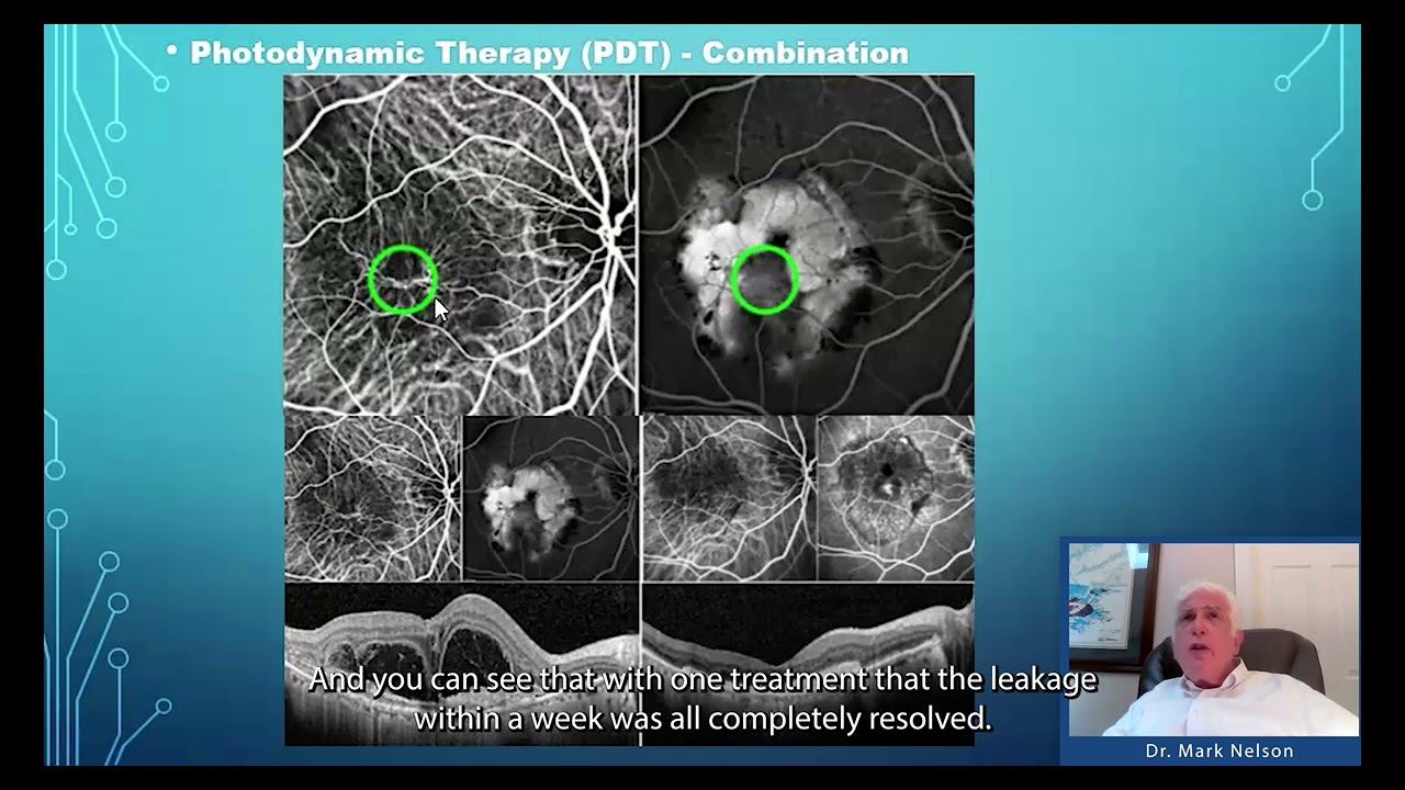 Dr. Mark H. Nelson Discusses PDT in Retinal Conditions - 2024 Update