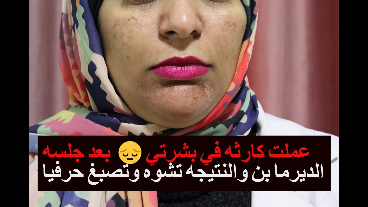 عملت كارثه في بشرتي😔 بعد جلسه الديرما بن والنتيجه تشوه وتصبغ حرفيا