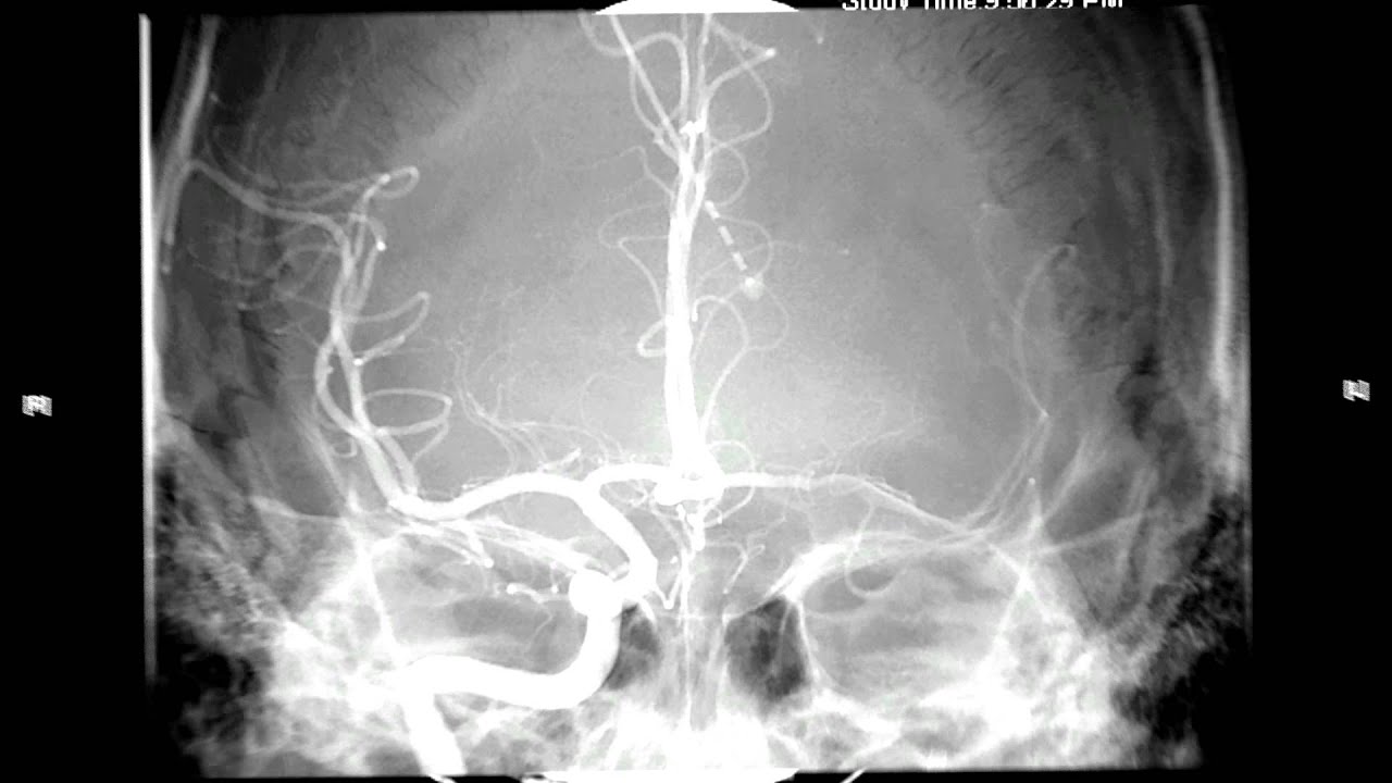 Balloon-assisted coil embolization of small intracranial aneurysms