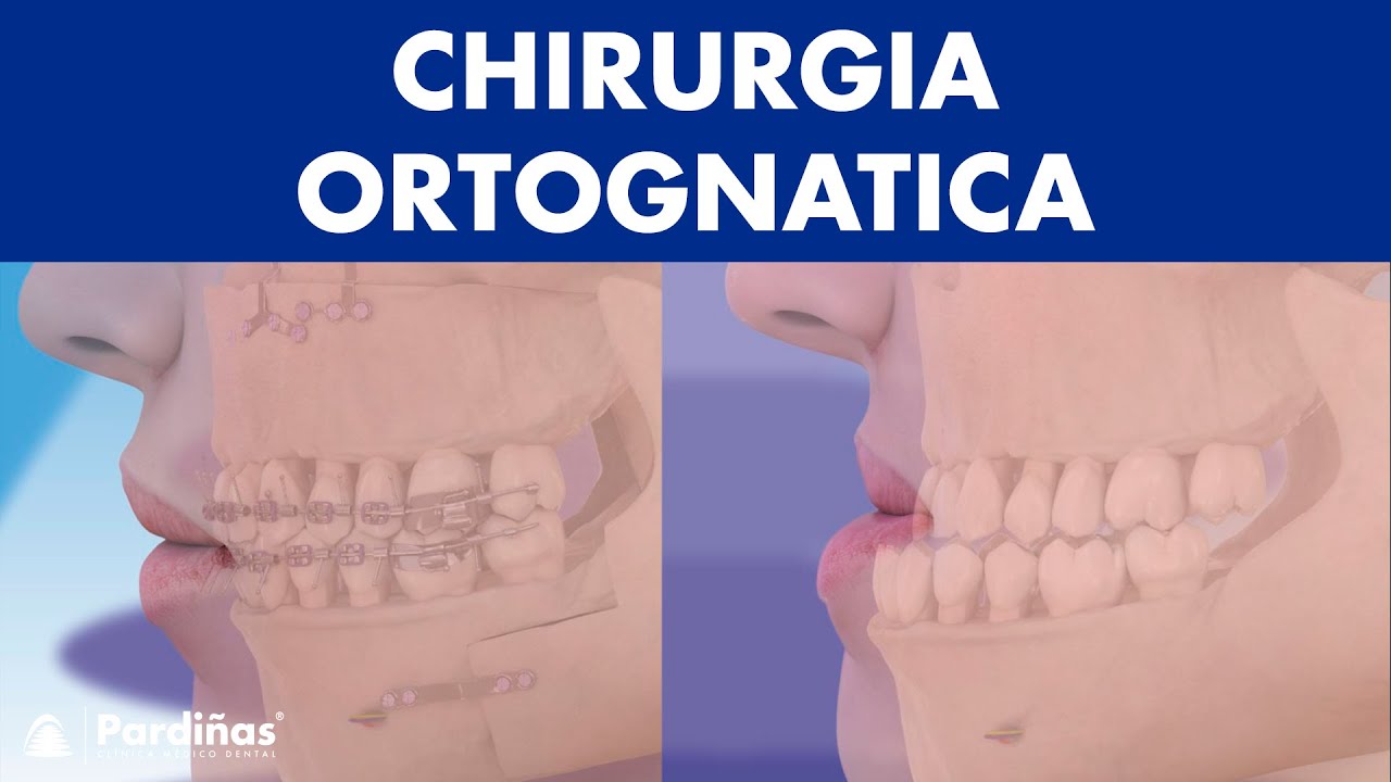 Chirurgia ORTOGNATICA - Operazione MANDIBOLA per correggere la sua posizione ©