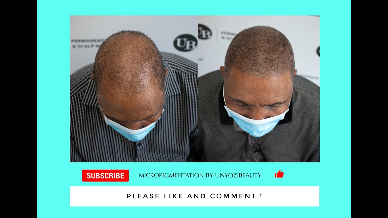 Toronto Scalp Micropigmentation | Client's Testimonial at Unyozi Beauty