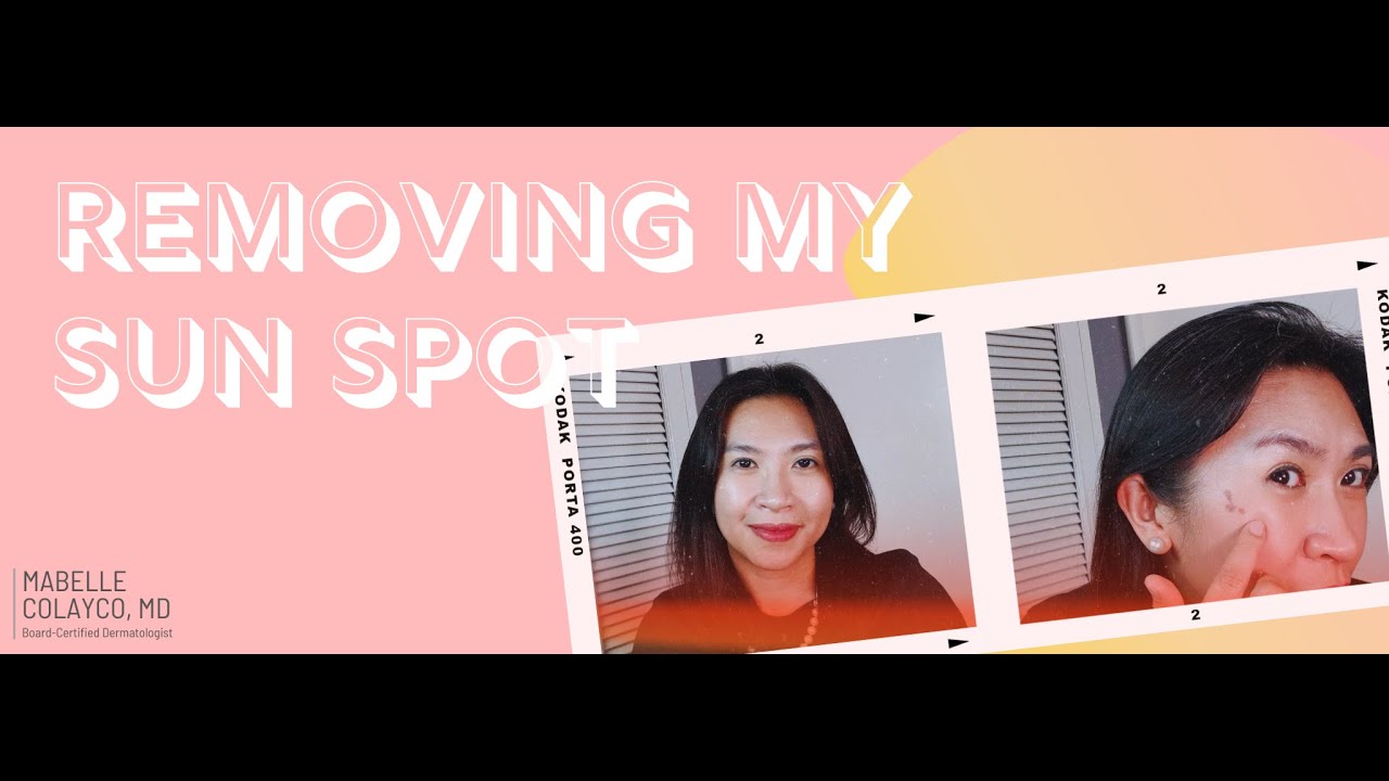 Removing my Sun Spot