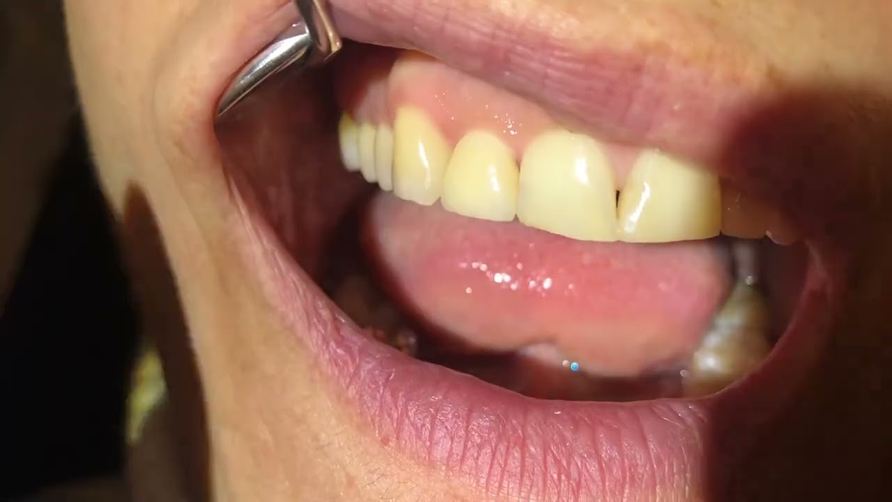 Vital-&Auml;sthetik mit Keramik Krone auf Keramik Implantat in der Front ⚕️ dr-gelberg.de