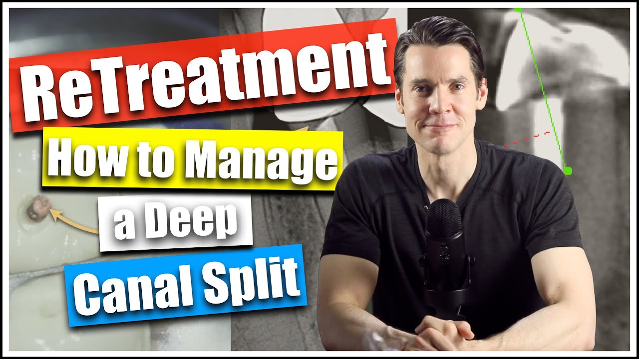 Root Canal Retreatment: How Manage a Deep Canal Split Dr William Nudera, Endodontist