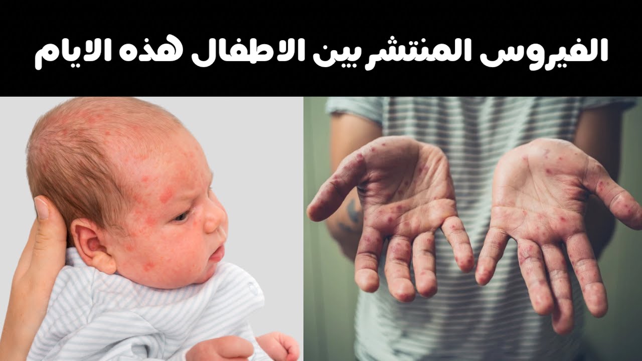 مرض اليد و القدم و الفم عند الاطفال اعراضه و علاجه و افضل طرق الوقاية