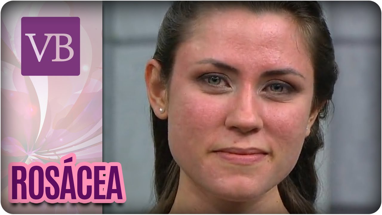 Rosácea - Você Bonita (08/09/16)