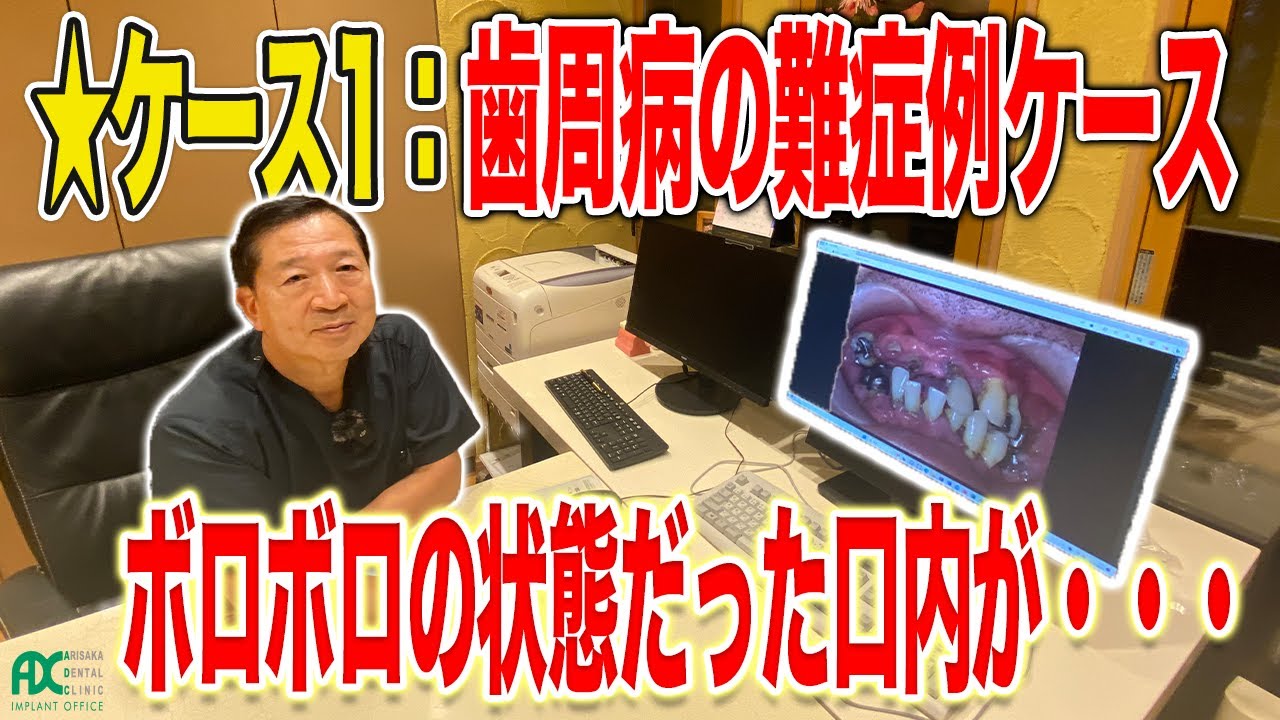ケース1：歯周病の難症例インプラントケース 有坂歯科