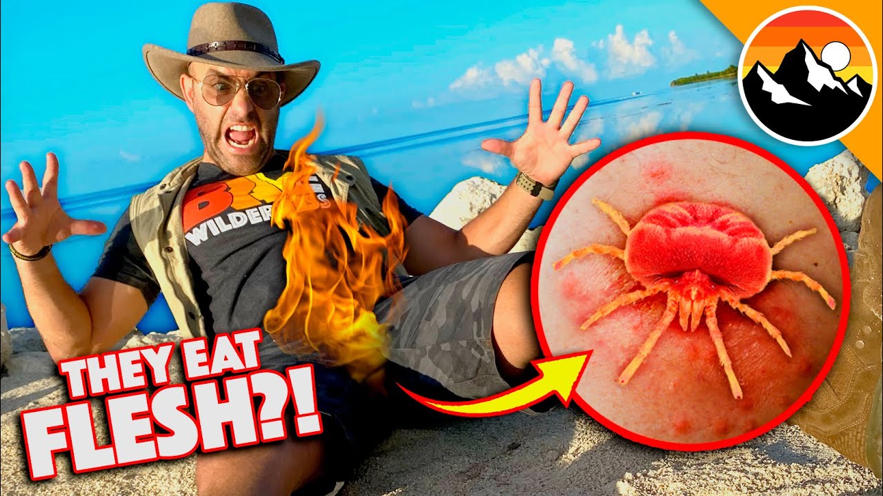 Bitten by Chiggers! Great Balls of FIRE!