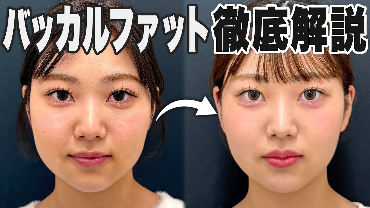 【最新版】今さら聞けないバッカルファット除去のキホン