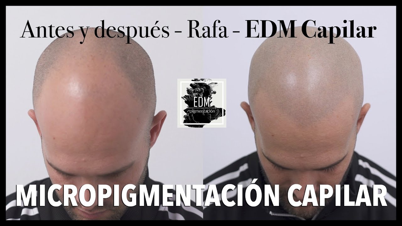 Antes y después en Micropigmentación capilar -  Testimonio real del caso de Jose