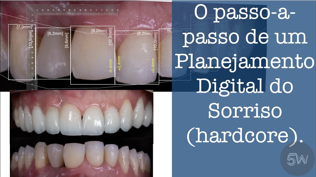 Tutorial de Planejamento digital do Sorriso [em um caso hardcore]