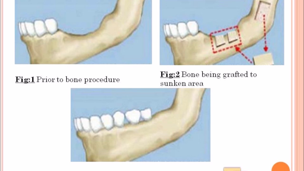 BONE GRAFTS IN DENTISTRY | PRF | BONE REGENERATION | SOCKET PRESERVATION