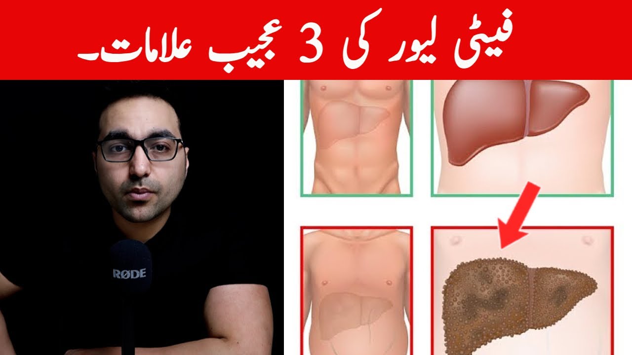 Dr. Zee:3 Weird Signs & Symptoms Of Fatty Liver | डॉक्टर ज़ी