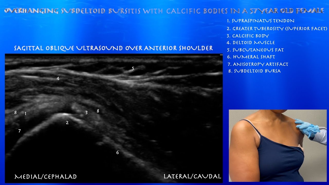 Ultrasound of a Mild Subdeltoid Bursitis with Calcific Bodies in the Overhanging Aspect of the Bursa
