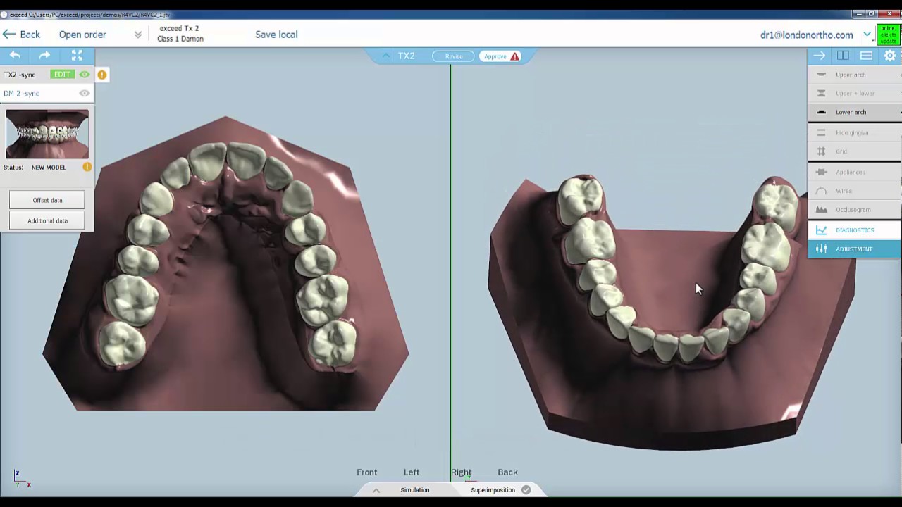 Unit 1 - eXceed Aligners, Indirect Bonding Software Introduction