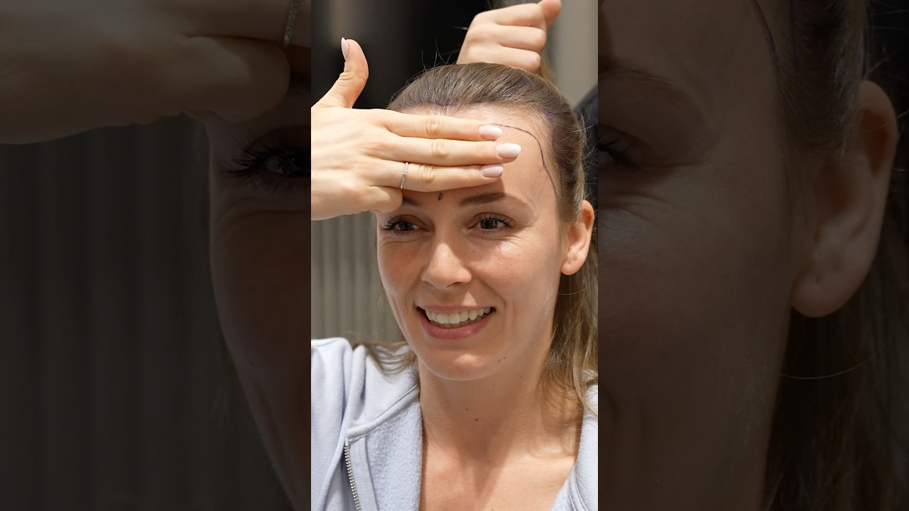 Forehead Reduction Hair Transplant in Turkey - Cosmedica Clinic #shorts #hairtransplant #video