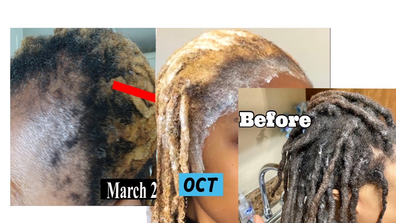 I start Growing my hair since may 2021 & NOW where in OCT 2021 now! NEW UPDATE MY ALOPECIA JOURNEY