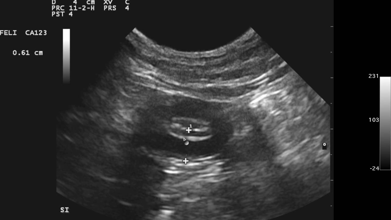 SonoPodcast - Feline Intestinal Thickening and Obstructive Pattern