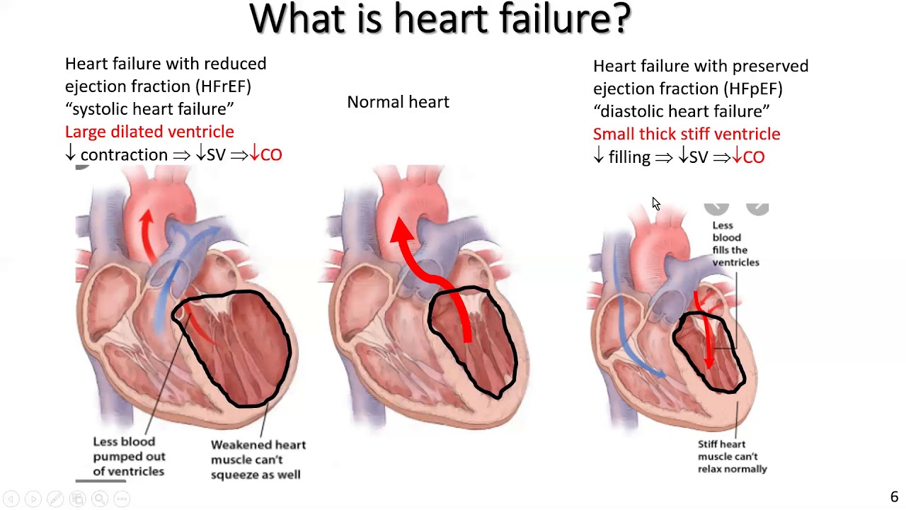 Chronic heart failure and exercise for exercise professionals: part 3: HFrEF; case study 3