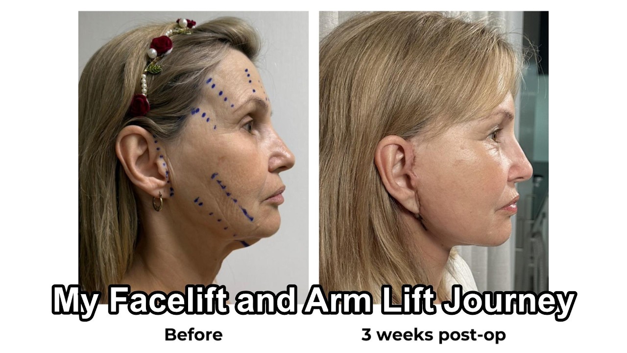 My Facelift and Arm lift Journey with Destination Beauty Bangkok Thailand Feb 2026