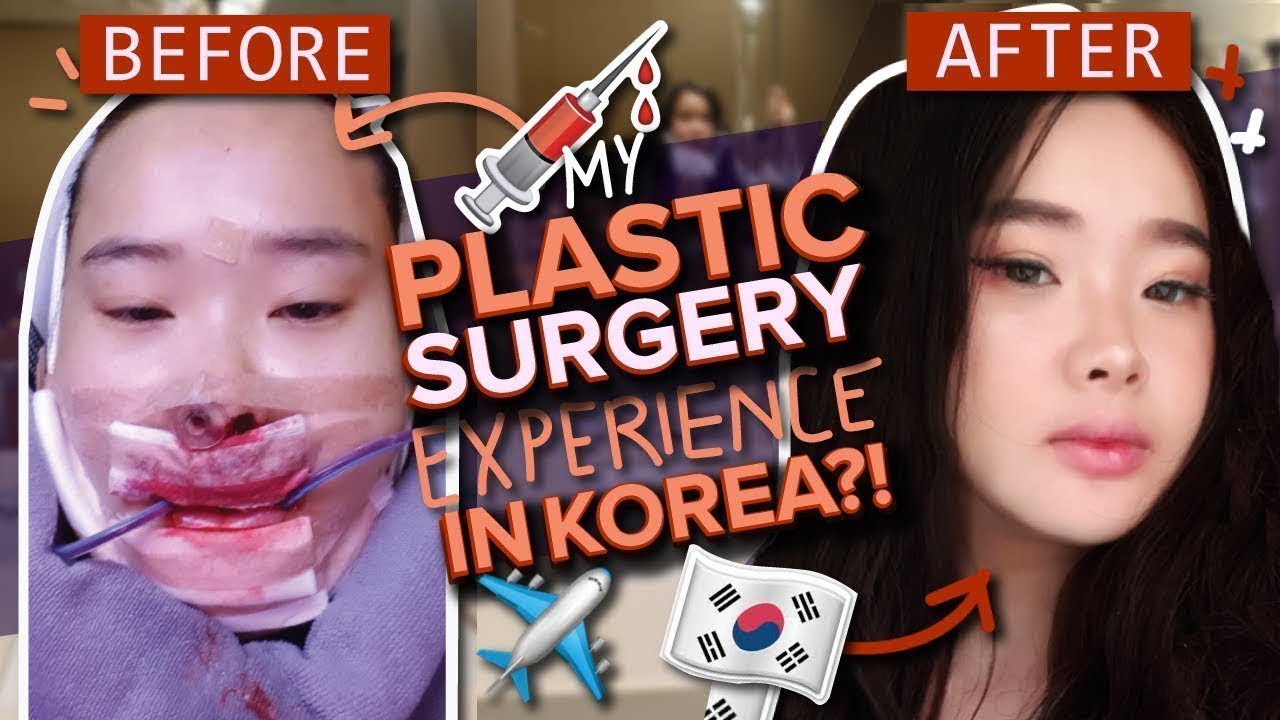 FOODTALES MUCKBANG  YOUTUBER's  two jaw + vline surgery experience at ID hospital, Korea (part 1)