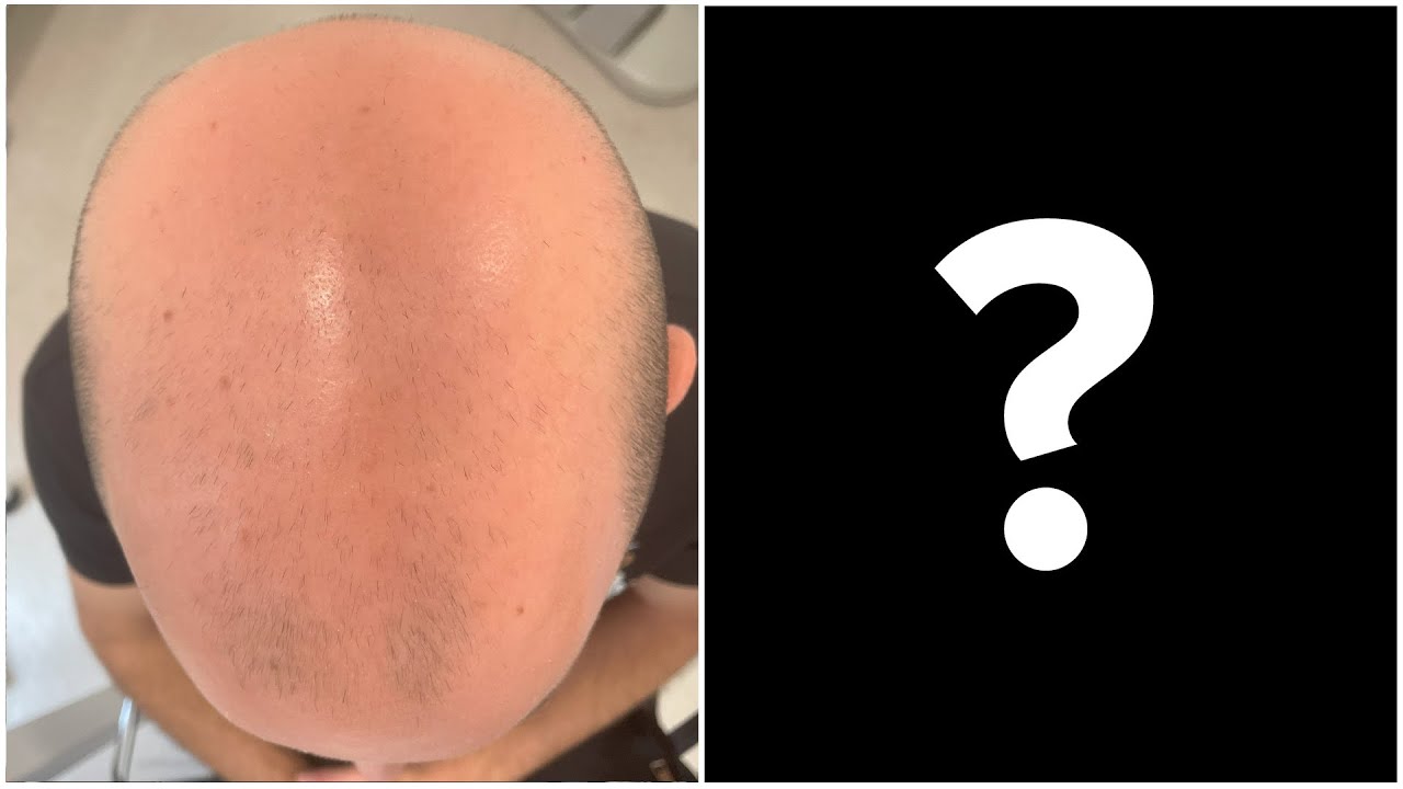📸 Analizando el ANTES y DESPUÉS de un PACIENTE que recuperó gran parte de su pelo en 3 meses