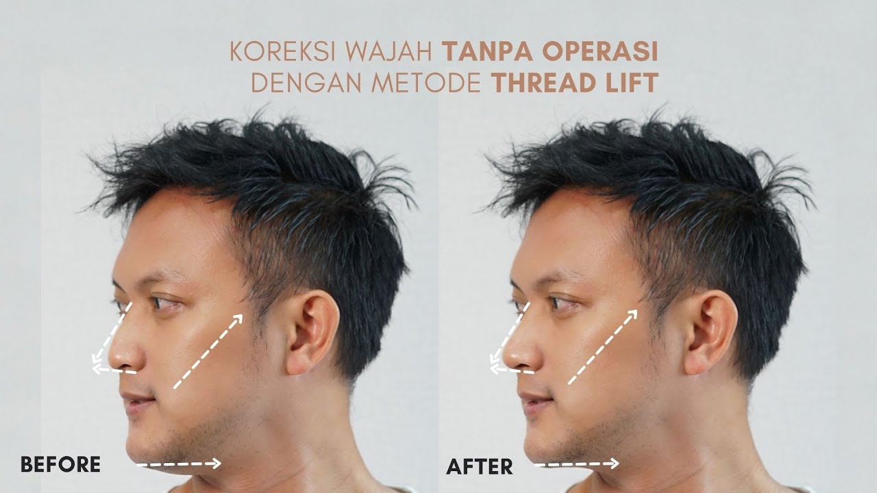 Perawatan Threadlift di Natasha Skin Clinic Center