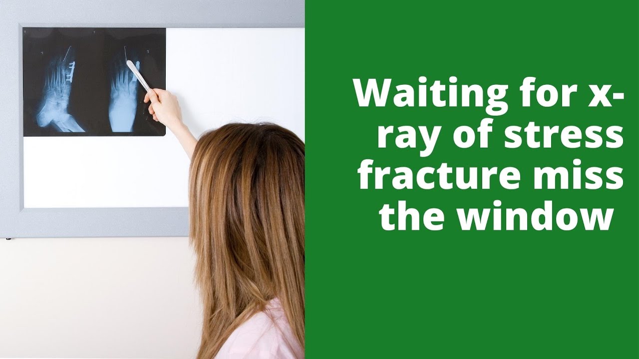 Waiting for x ray of stress fracture miss the window