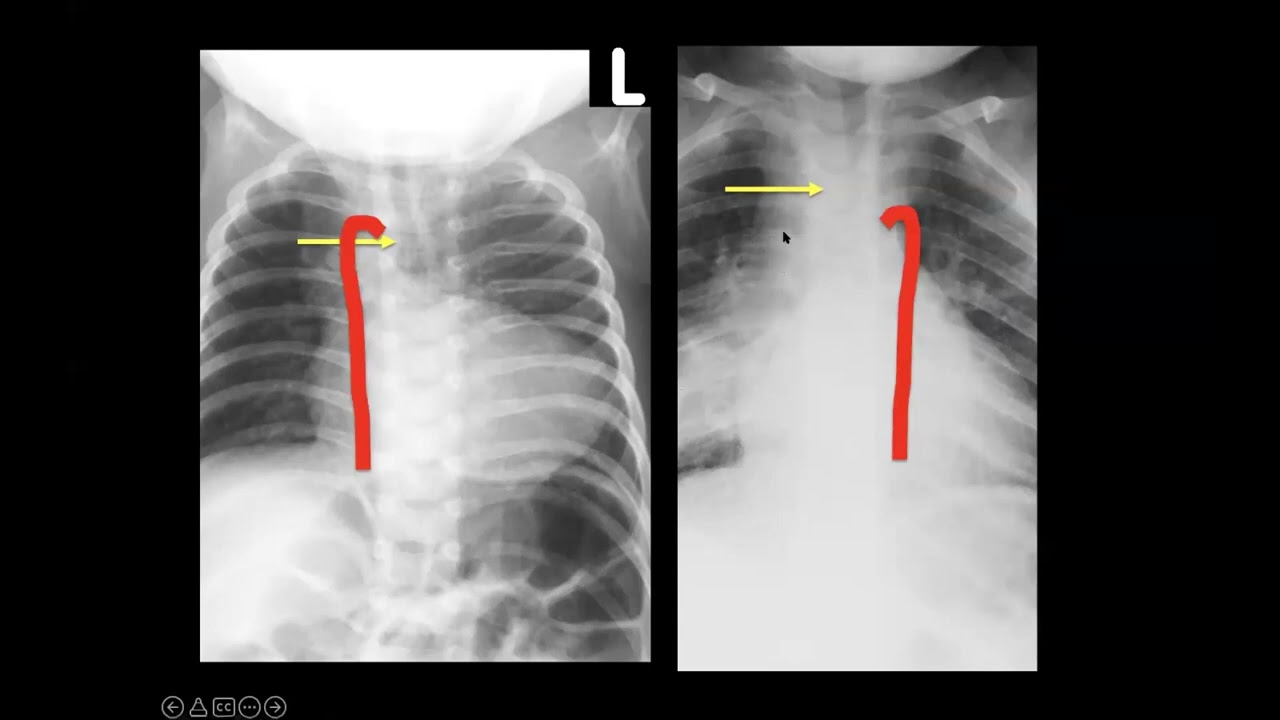 Paediatric CXR interpretation: Tips and tricks