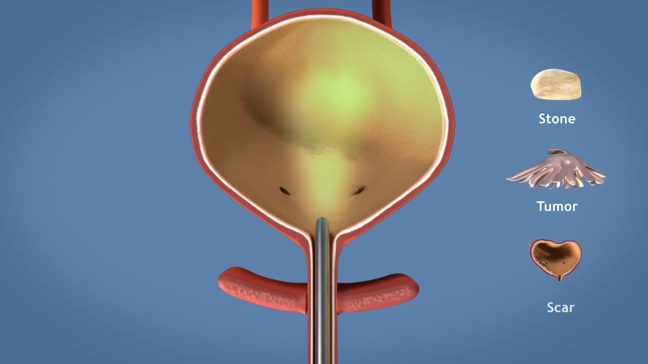 Cystoscopie