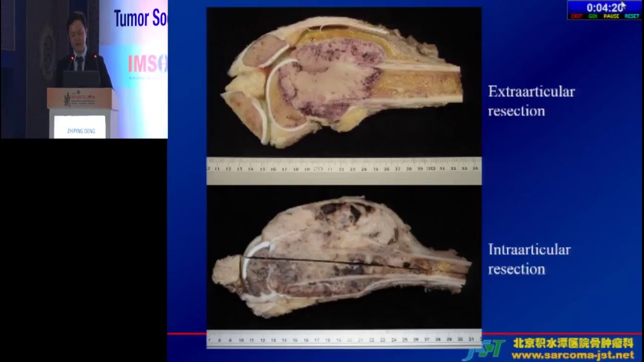 Is the local recurrence rate different for intra-articular and extra-...- Zhiping Deng
