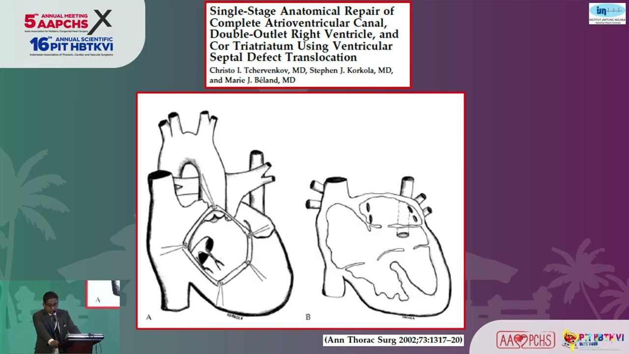 DORV with Atrioventricular Septal Defect - Sivakumar Sivalingam