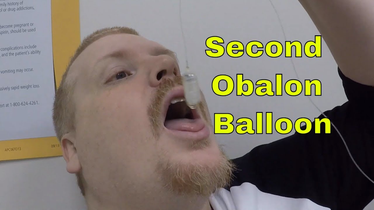 Second Obalon Balloon